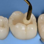 دندان پزشکی بیومیمتیک چیست ؟