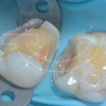 سیل فوری عاج